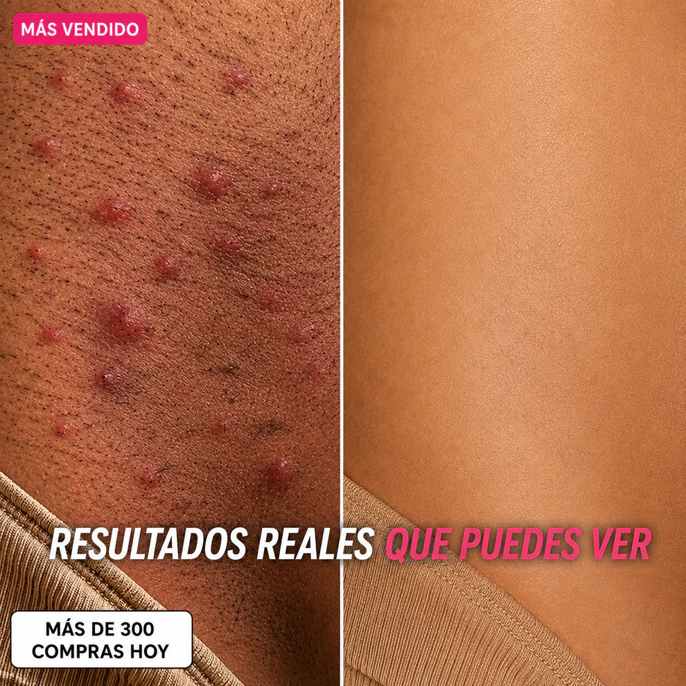 Aceite Cyperus - Adiós Depilación Constante